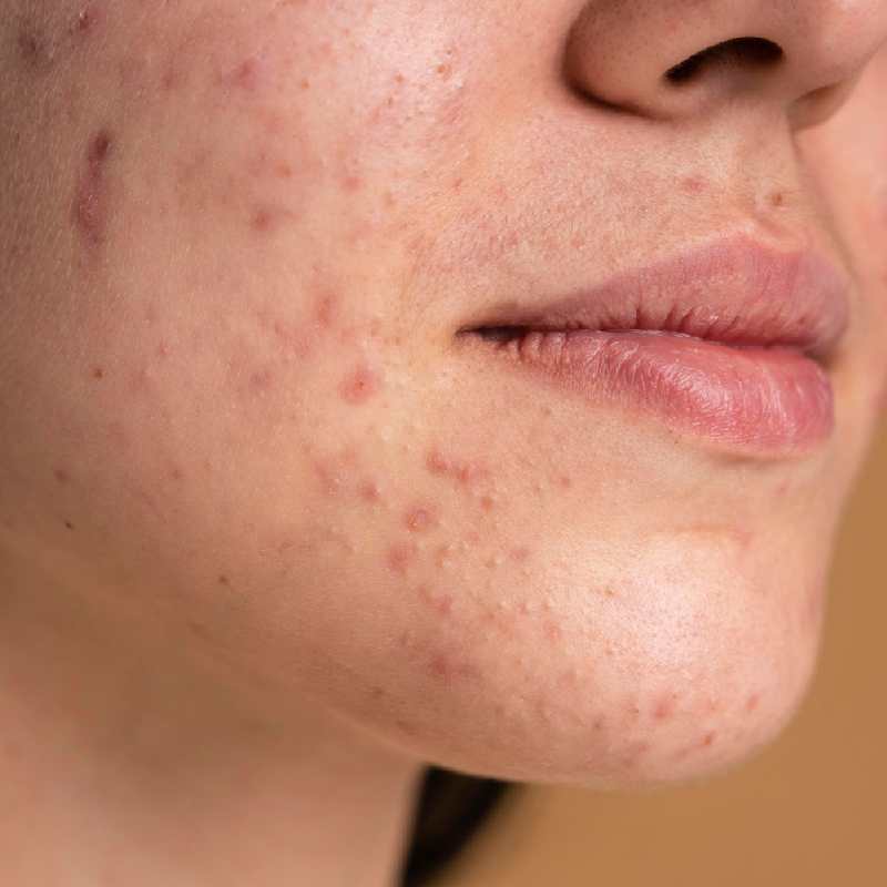 Acne Scarring
