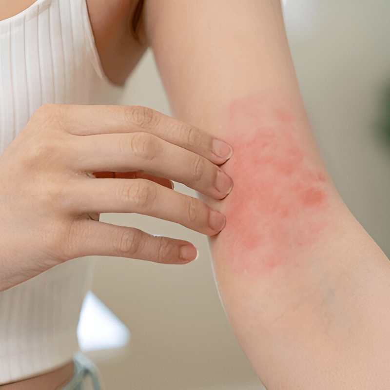 Eczema Treatment