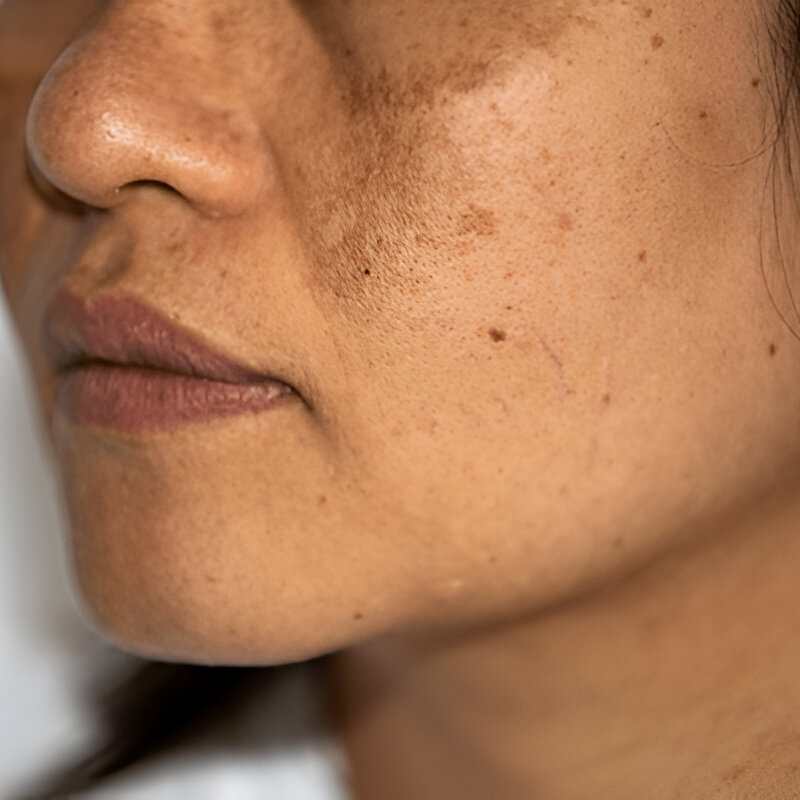 Hyperpigmentation