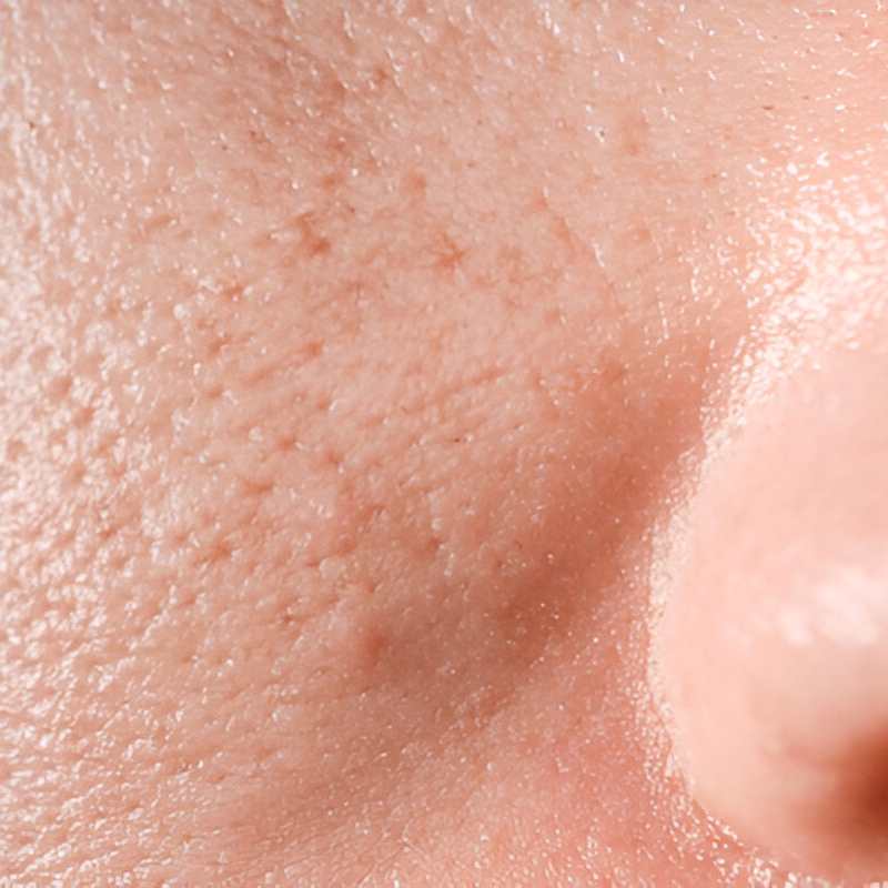 Prominent or Large Pores