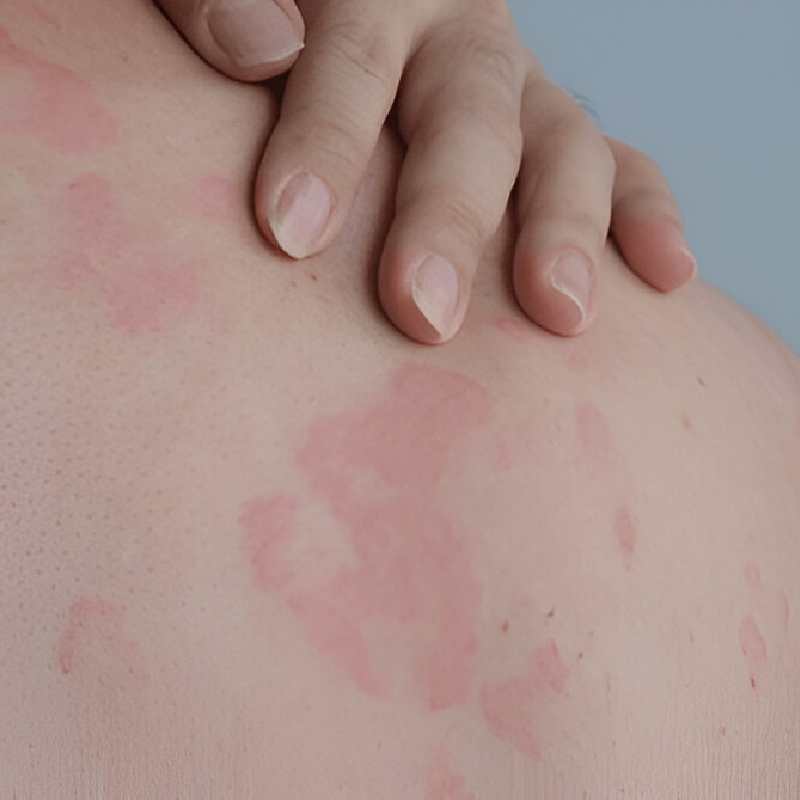 Urticaria
