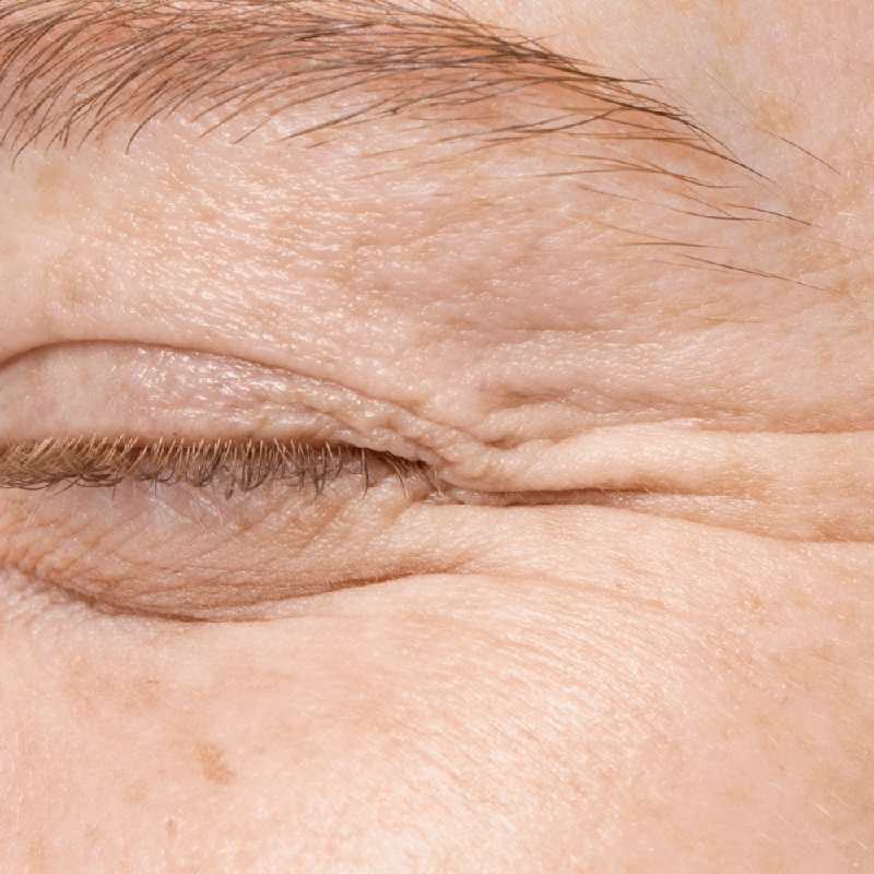 Wrinkles and Fine Lines