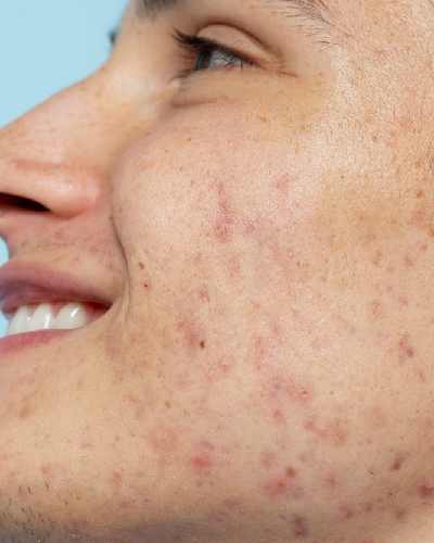 Pigmentation