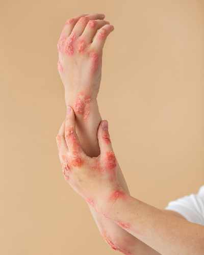 Redness & Vascularity