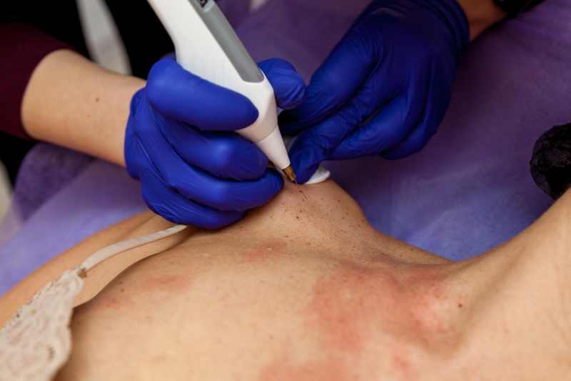 Removal of papillomas