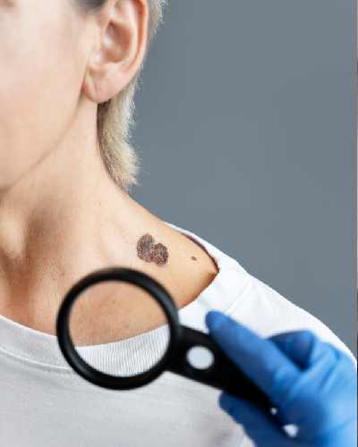 Skin Growth &TumourTreatment