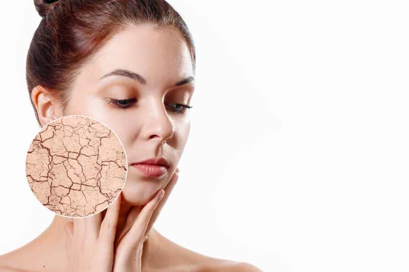 dry facial skin
