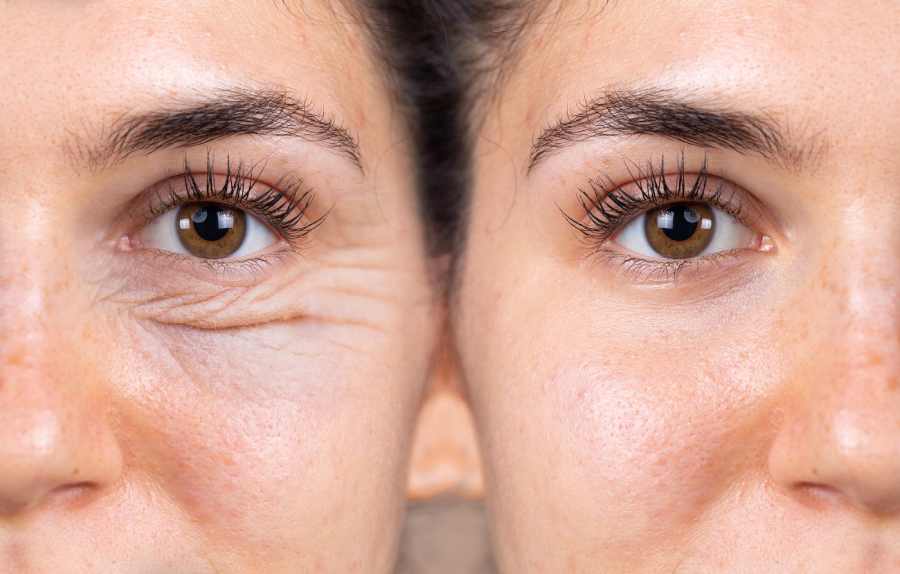 before and after results of successful blepharoplas